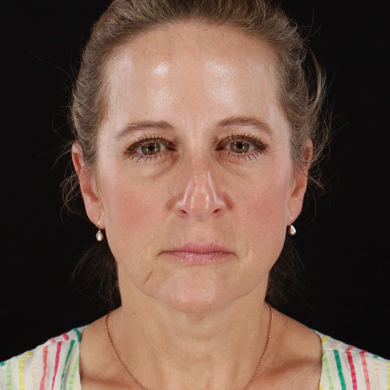 Dysport Before & After Gallery - Patient 239818 - Image 4