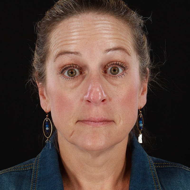 Dysport Before & After Gallery - Patient 239818 - Image 1