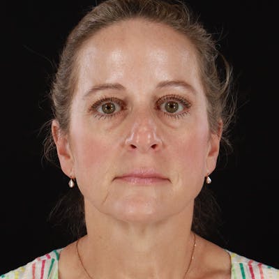 Dysport Before & After Gallery - Patient 239818 - Image 2