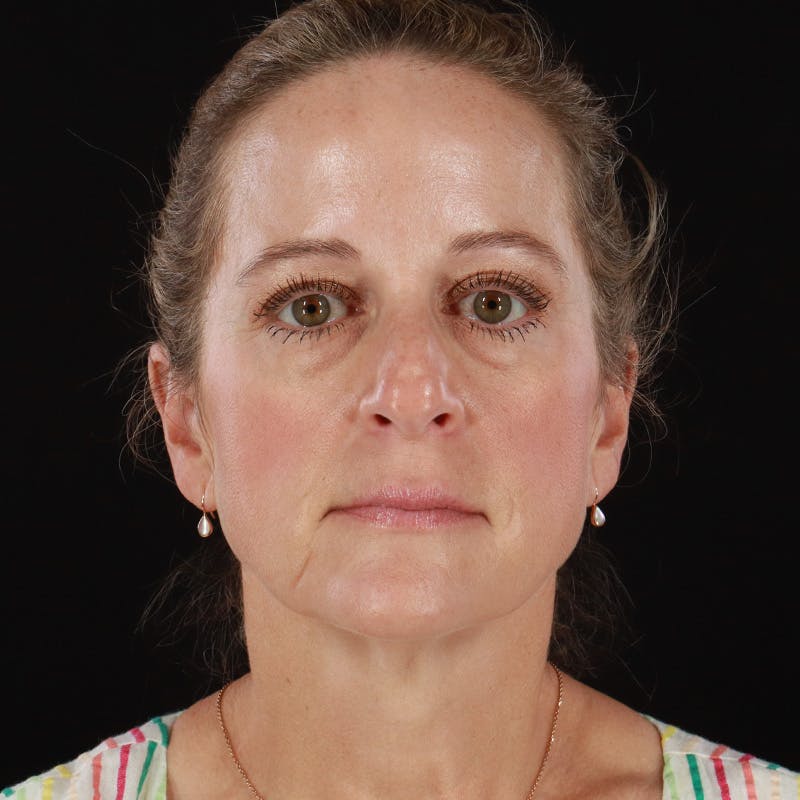 Dysport Before & After Gallery - Patient 239818 - Image 2