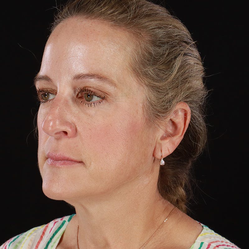 Dysport Before & After Gallery - Patient 239818 - Image 12