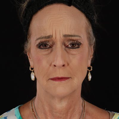 Dysport Before & After Gallery - Patient 356356 - Image 1