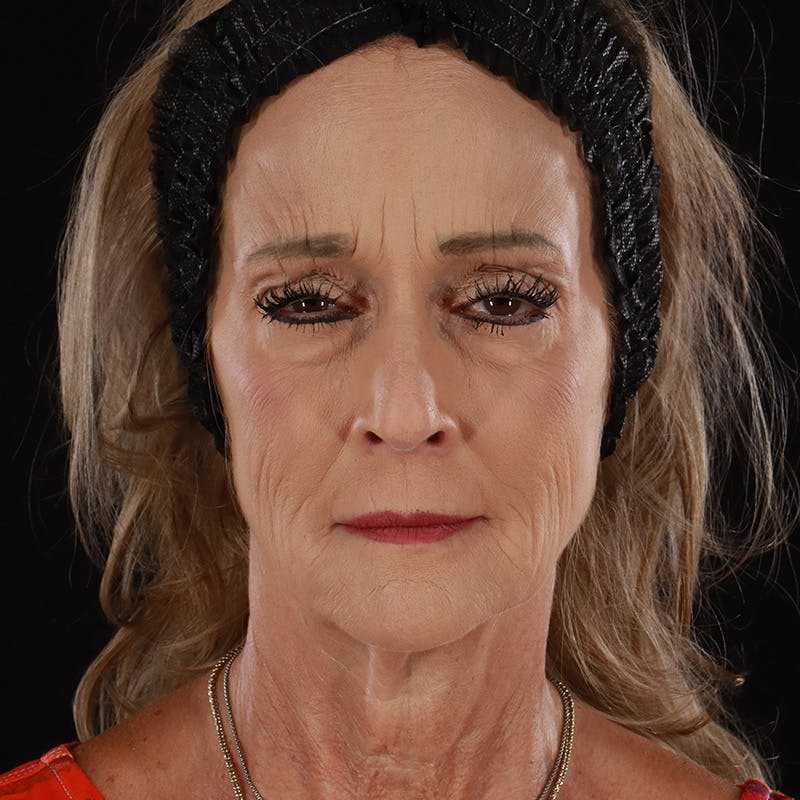 Dysport Before & After Gallery - Patient 356356 - Image 2
