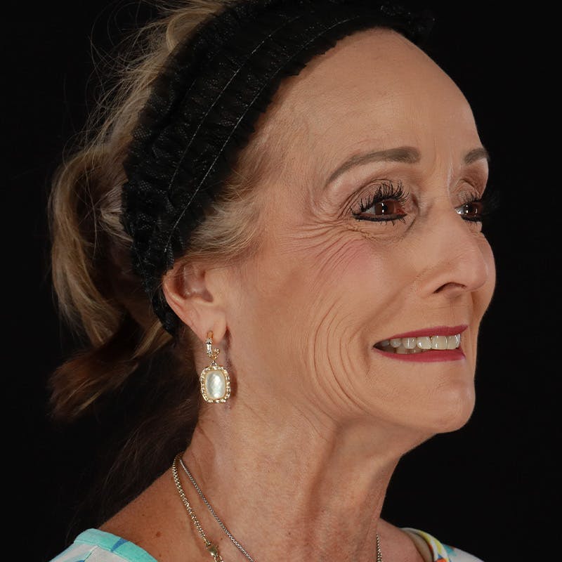 Dysport Before & After Gallery - Patient 356356 - Image 5