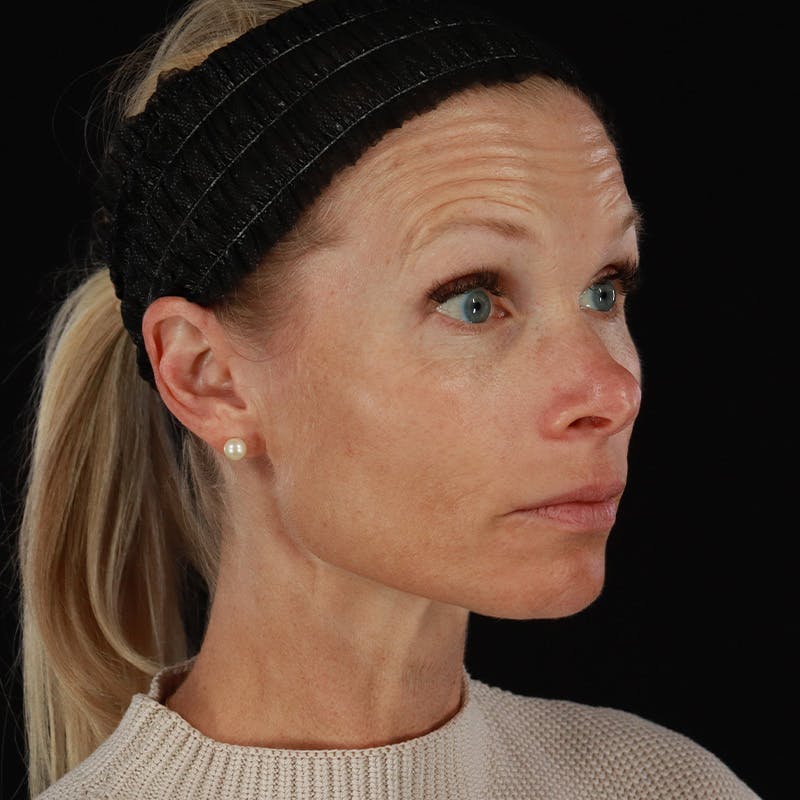 Microneedling Before & After Gallery - Patient 220593 - Image 3