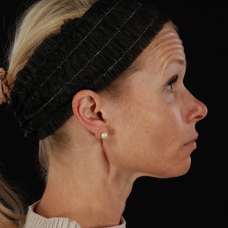 Microneedling Before & After Gallery - Patient 220593 - Image 5