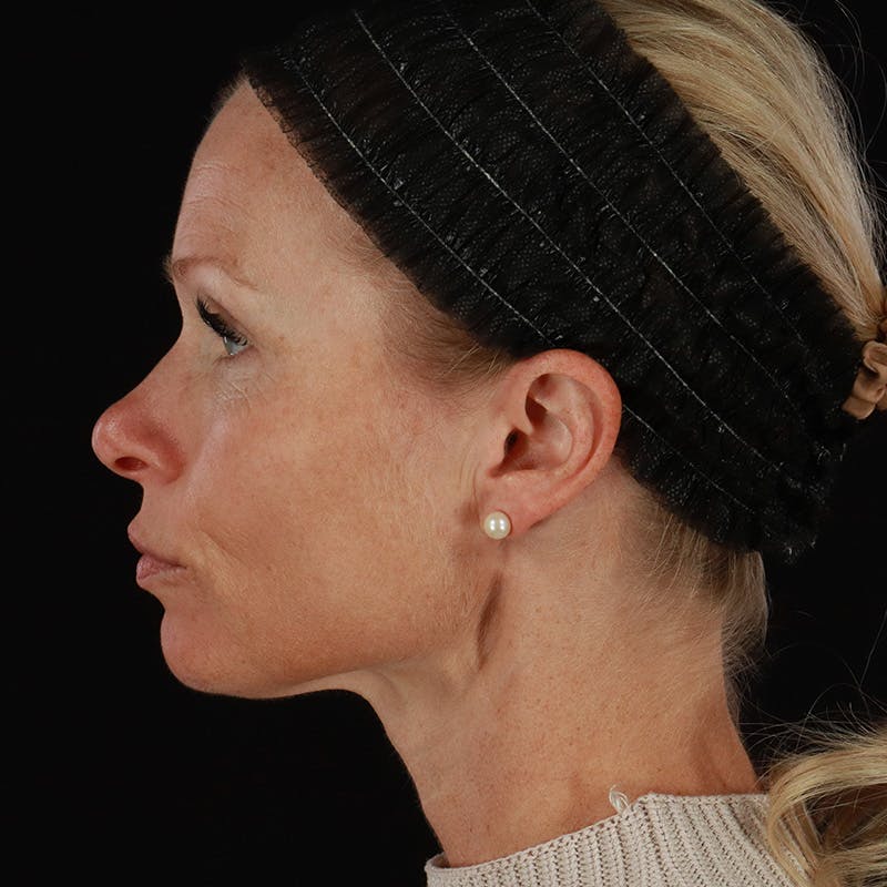 Microneedling Before & After Gallery - Patient 220593 - Image 9