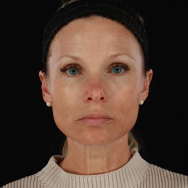 Microneedling Before & After Gallery - Patient 220593 - Image 1