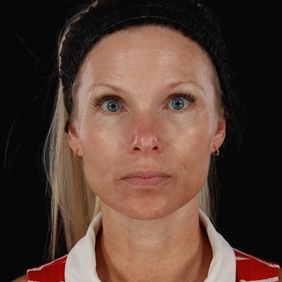 Microneedling Before & After Gallery - Patient 220593 - Image 2