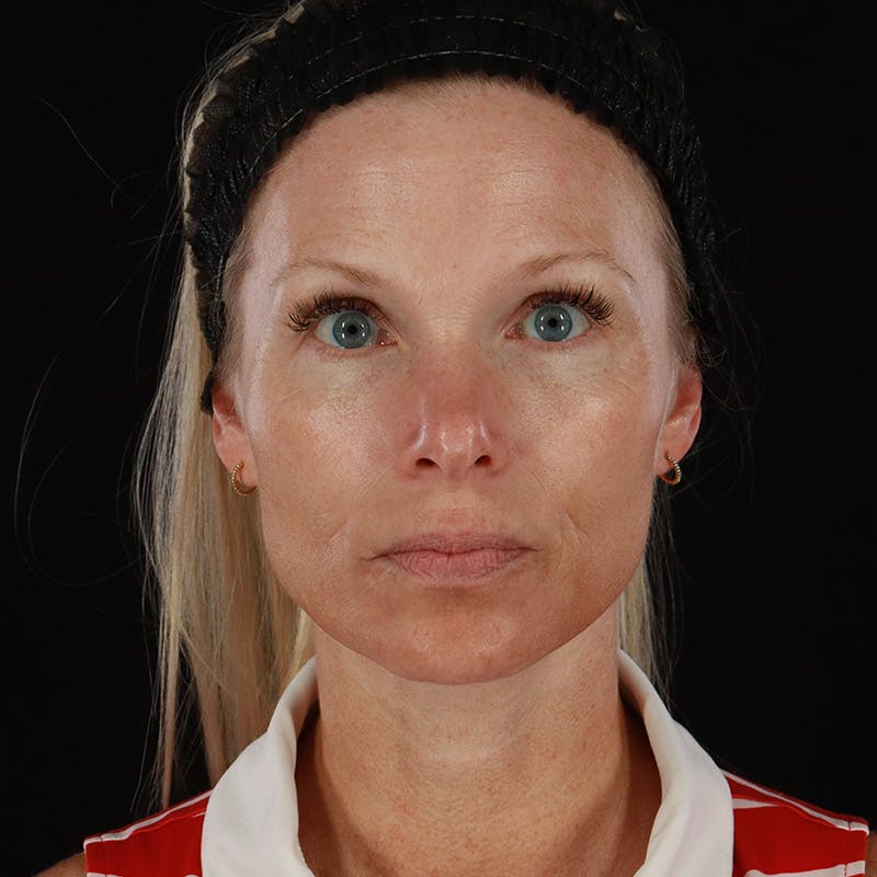 Microneedling Before & After Gallery - Patient 220593 - Image 2