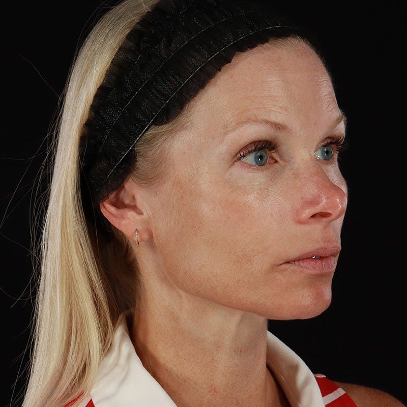 Microneedling Before & After Gallery - Patient 220593 - Image 4