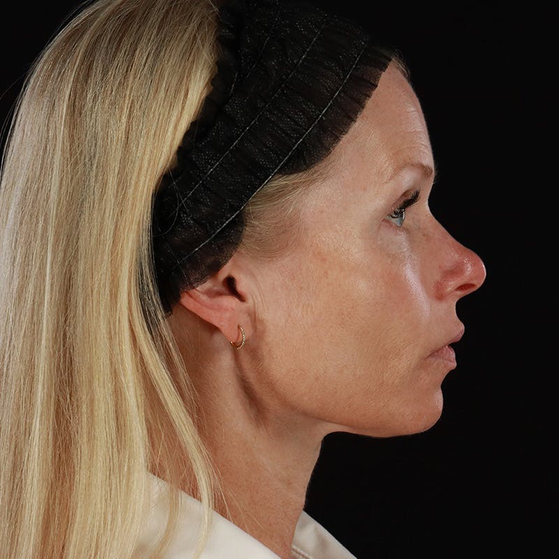 Microneedling Before & After Gallery - Patient 220593 - Image 6