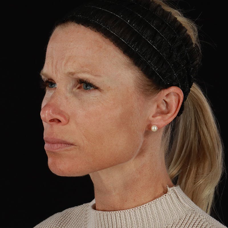 Microneedling Before & After Gallery - Patient 220593 - Image 7