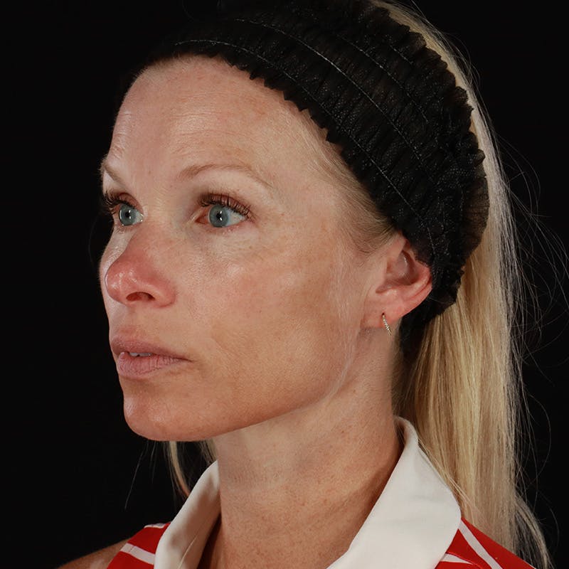 Microneedling Before & After Gallery - Patient 220593 - Image 8