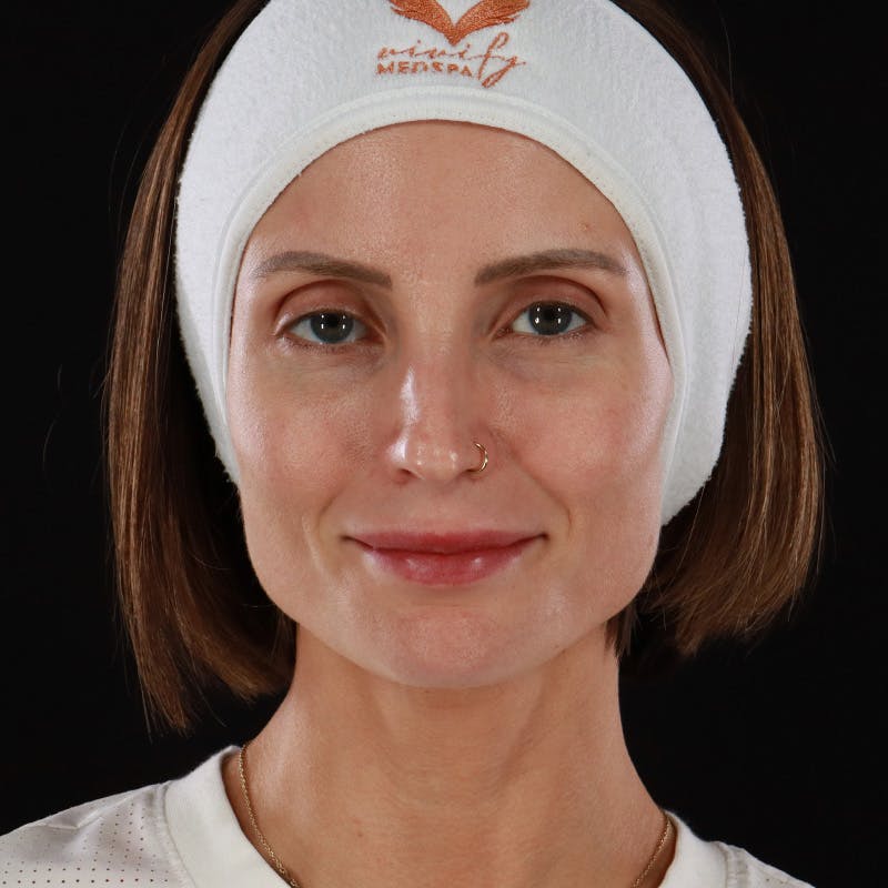 Microneedling Before & After Gallery - Patient 240868 - Image 2