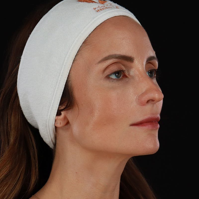 Microneedling Before & After Gallery - Patient 240868 - Image 3