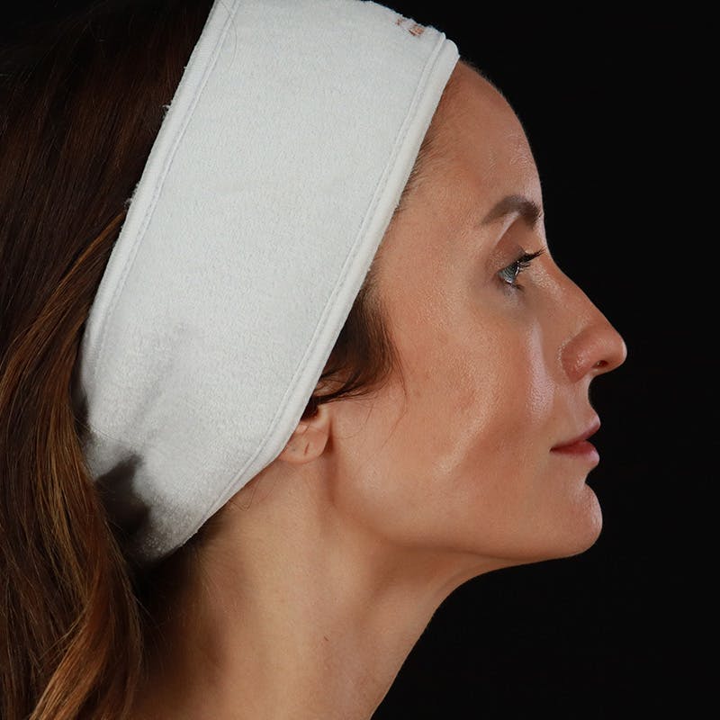 Microneedling Before & After Gallery - Patient 240868 - Image 5