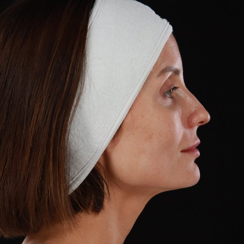 Microneedling Before & After Gallery - Patient 240868 - Image 6