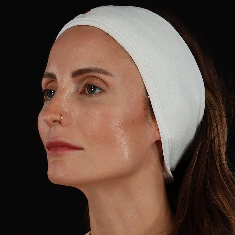 Microneedling Before & After Gallery - Patient 240868 - Image 7