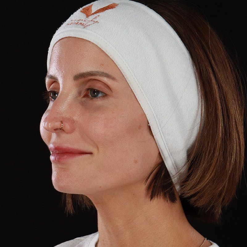 Microneedling Before & After Gallery - Patient 240868 - Image 8
