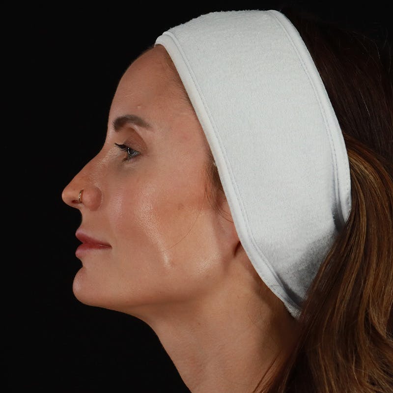 Microneedling Before & After Gallery - Patient 240868 - Image 9