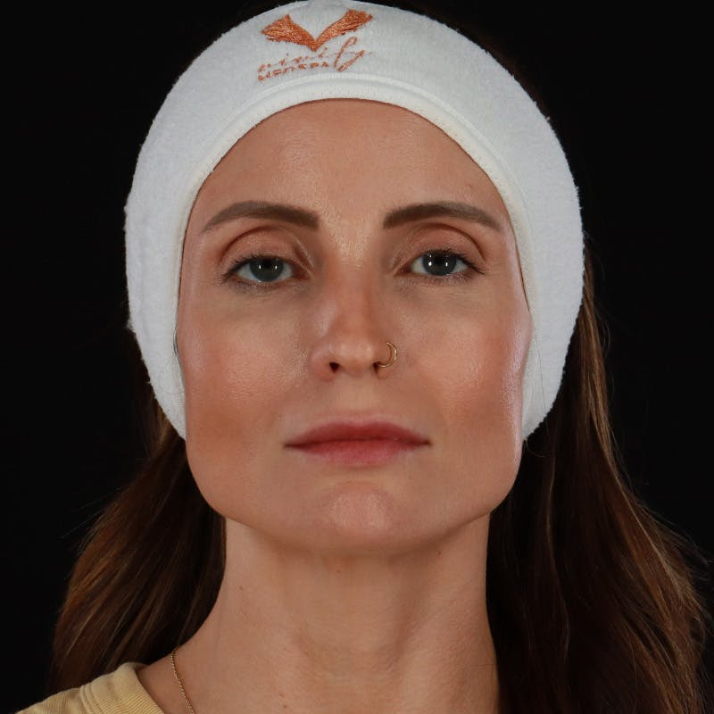 Microneedling Before & After Gallery - Patient 240868 - Image 1
