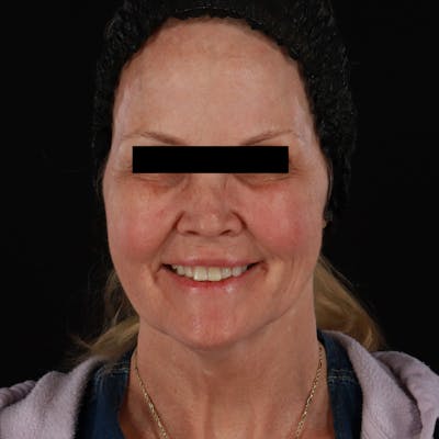 Microneedling Before & After Gallery - Patient 975502 - Image 1