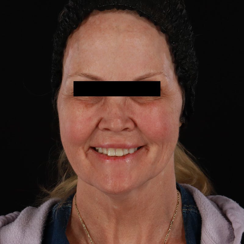 Microneedling Before & After Gallery - Patient 975502 - Image 1