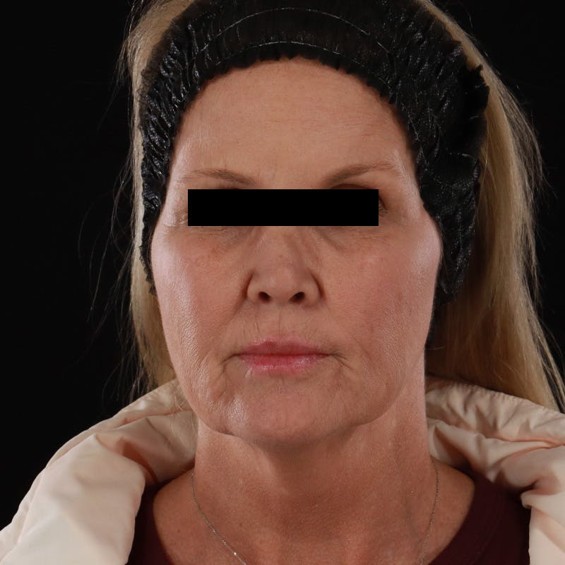 Microneedling Before & After Gallery - Patient 975502 - Image 2