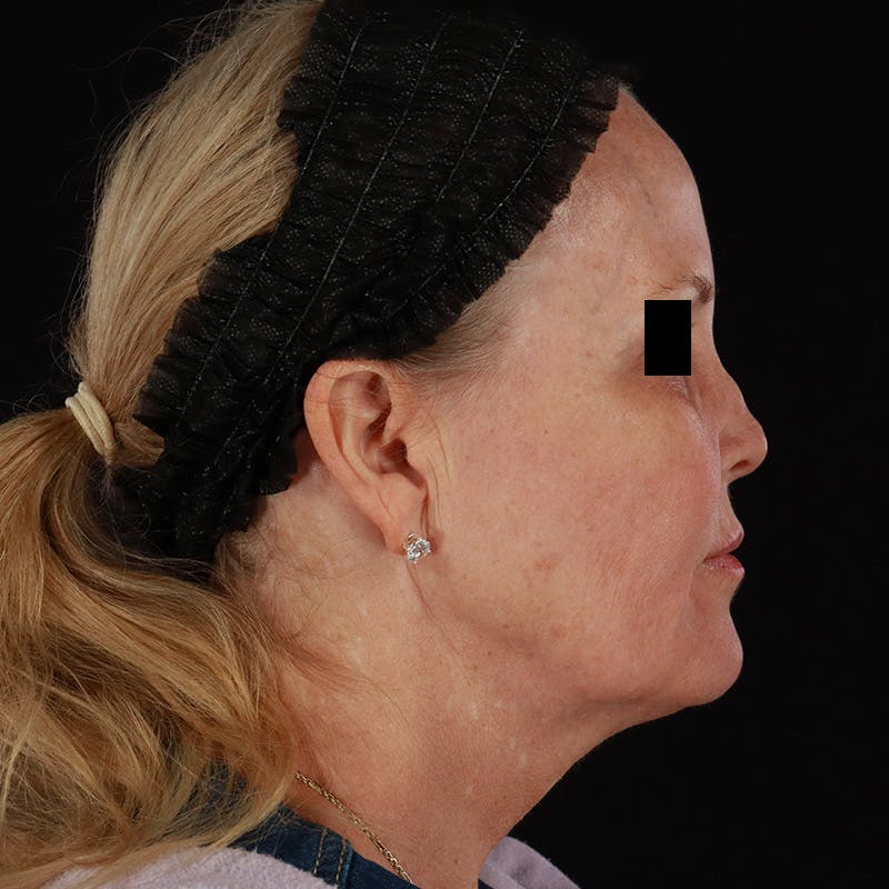 Microneedling Before & After Gallery - Patient 975502 - Image 5