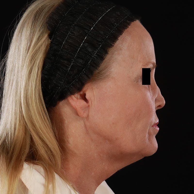 Microneedling Before & After Gallery - Patient 975502 - Image 6