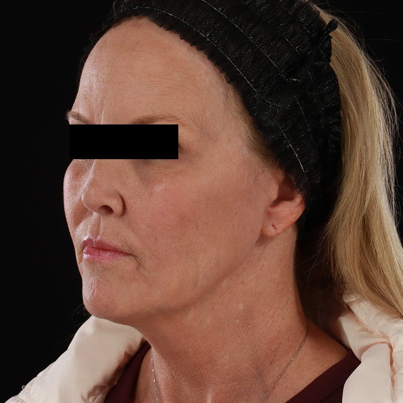 Microneedling Before & After Gallery - Patient 975502 - Image 8