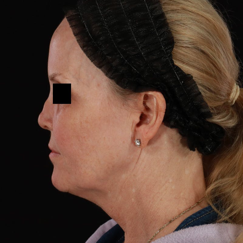 Microneedling Before & After Gallery - Patient 975502 - Image 9