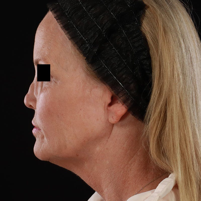 Microneedling Before & After Gallery - Patient 975502 - Image 10