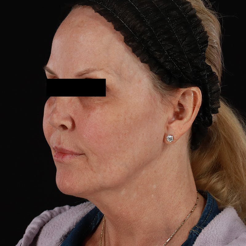 Microneedling Before & After Gallery - Patient 975502 - Image 7