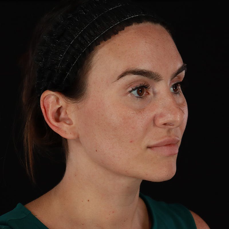 Dermal Fillers Before & After Gallery - Patient 283229 - Image 1