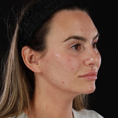 Dermal Fillers Before & After Gallery - Patient 283229 - Image 2