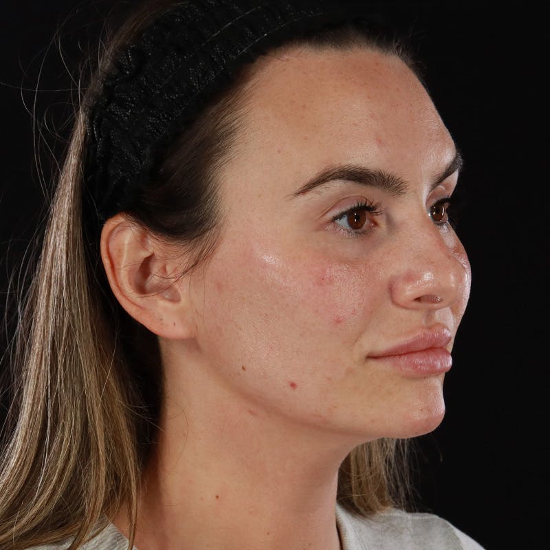 Dermal Fillers Before & After Gallery - Patient 283229 - Image 2