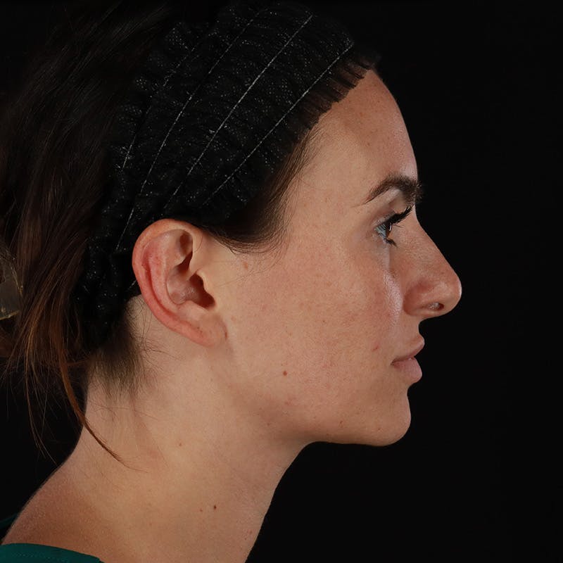 Dermal Fillers Before & After Gallery - Patient 283229 - Image 3