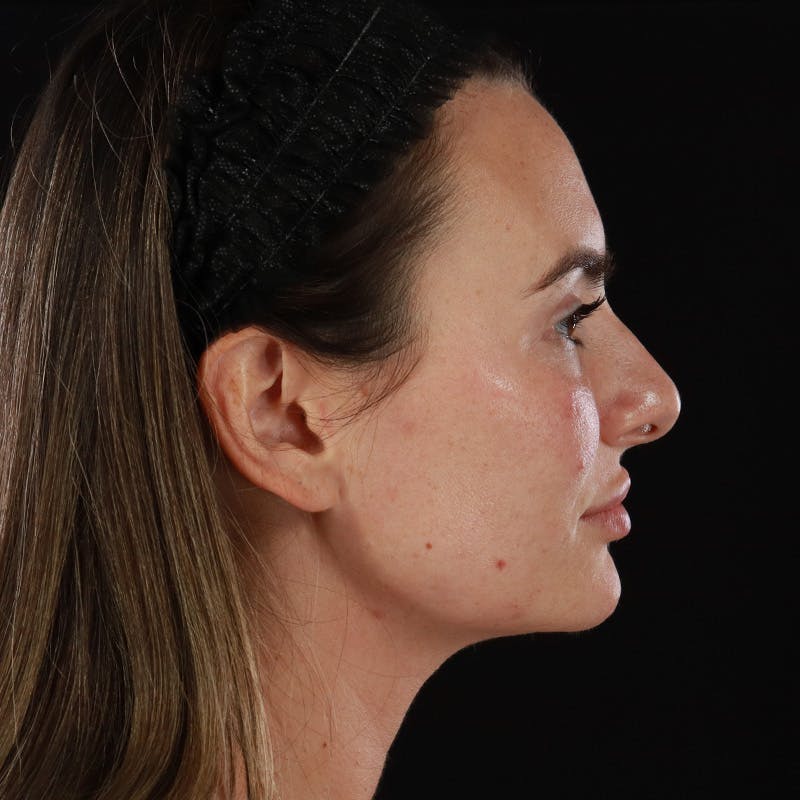 Dermal Fillers Before & After Gallery - Patient 283229 - Image 4