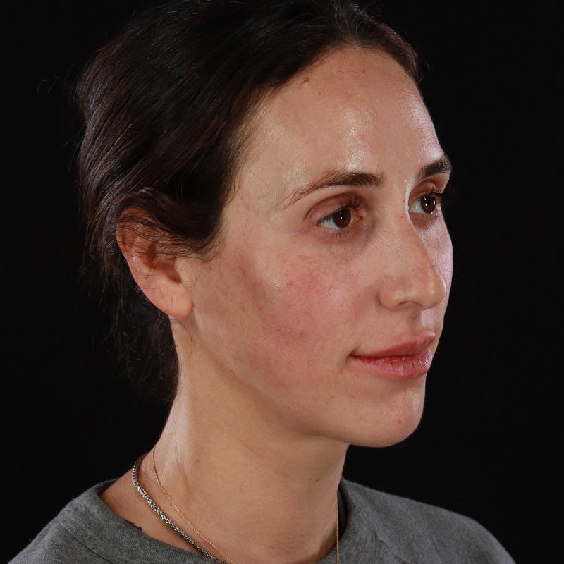 Dermal Fillers Before & After Gallery - Patient 180189 - Image 6