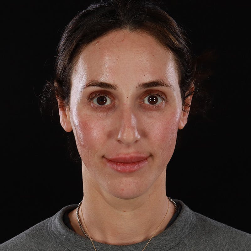 Dermal Fillers Before & After Gallery - Patient 180189 - Image 2