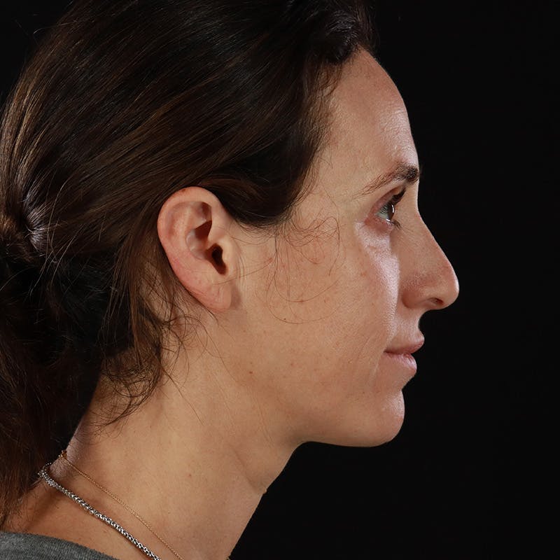 Dermal Fillers Before & After Gallery - Patient 180189 - Image 7