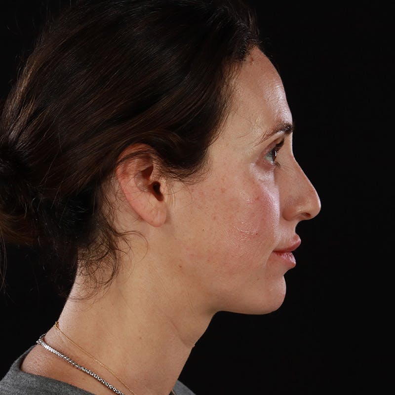 Dermal Fillers Before & After Gallery - Patient 180189 - Image 8