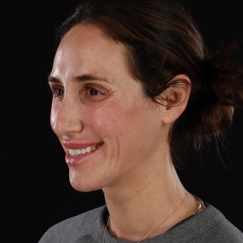 Dermal Fillers Before & After Gallery - Patient 180189 - Image 10