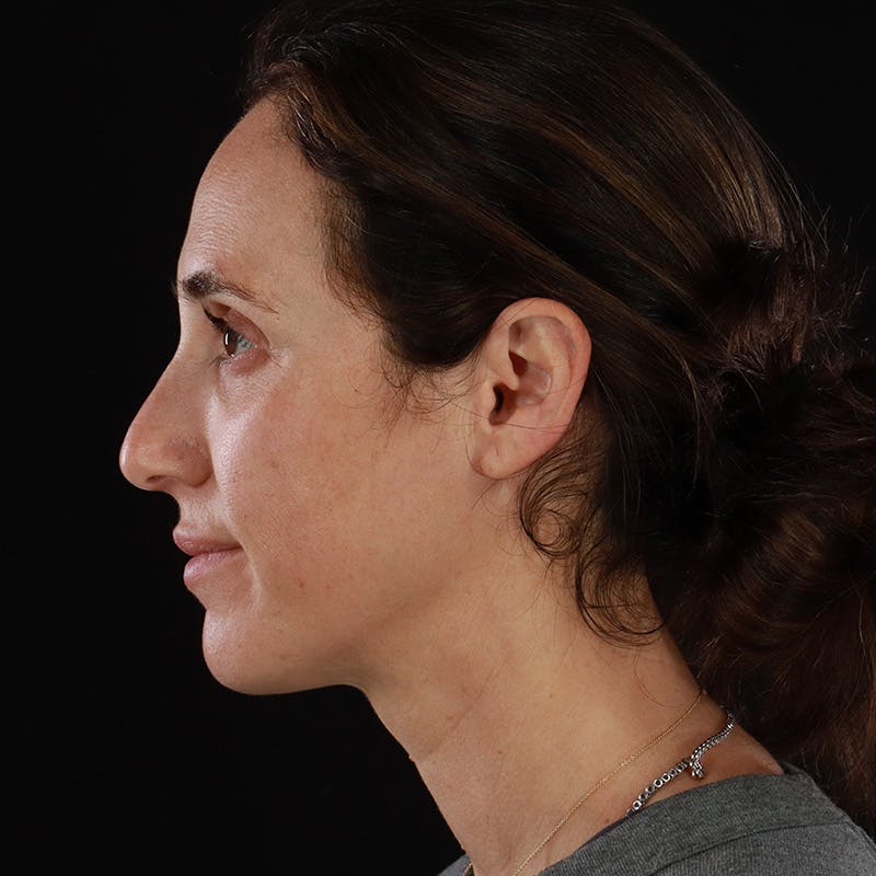 Dermal Fillers Before & After Gallery - Patient 180189 - Image 11