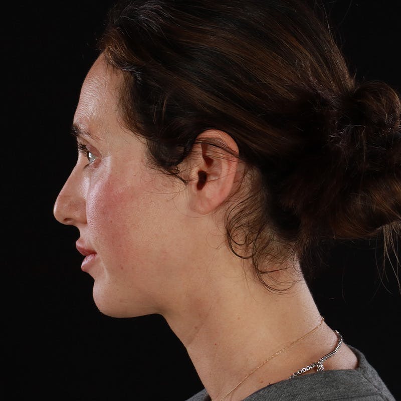 Dermal Fillers Before & After Gallery - Patient 180189 - Image 12