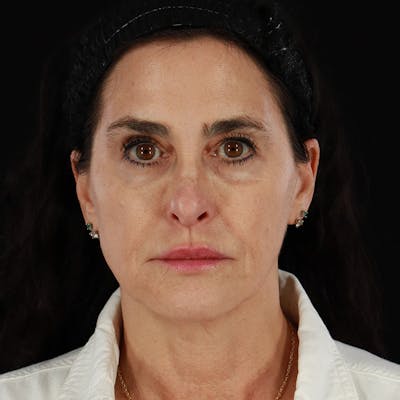 Dermal Fillers Before & After Gallery - Patient 904957 - Image 1
