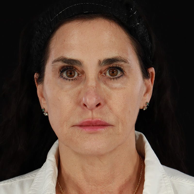 Dermal Fillers Before & After Gallery - Patient 904957 - Image 1