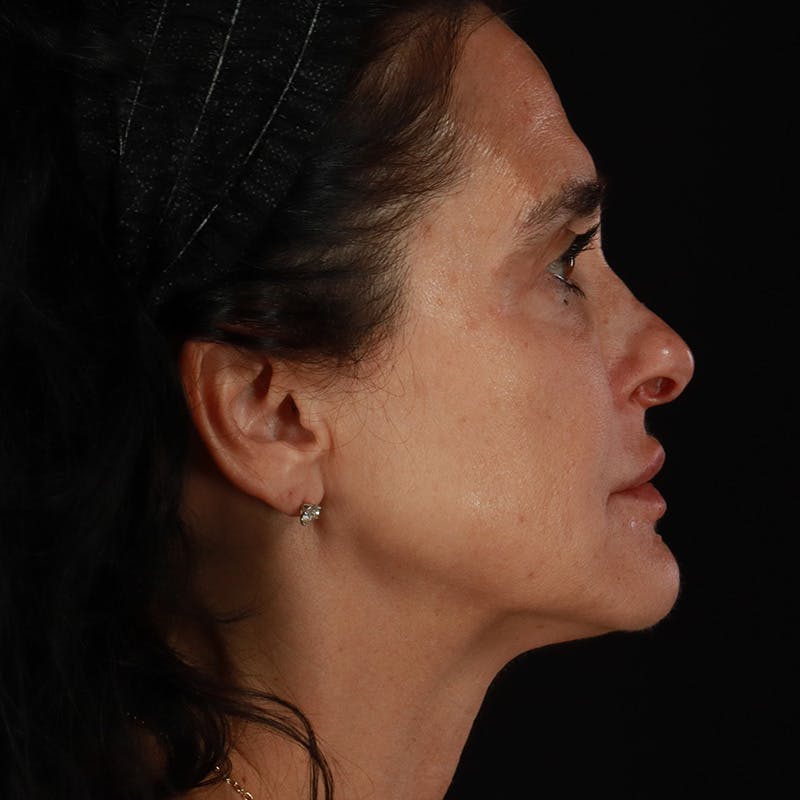 Dermal Fillers Before & After Gallery - Patient 904957 - Image 8